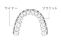 ワイヤー矯正